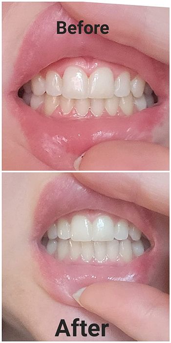 Before and after photos reveal how dramatically a reviewer's teeth were whitened using the pen.