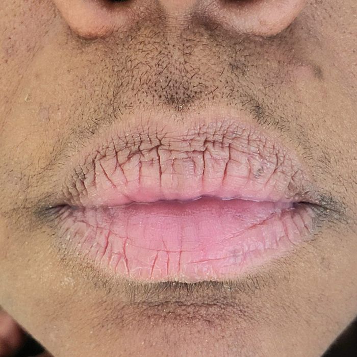 Before photo showing dark black hairs growing on a reviewer's upper lip and chin
