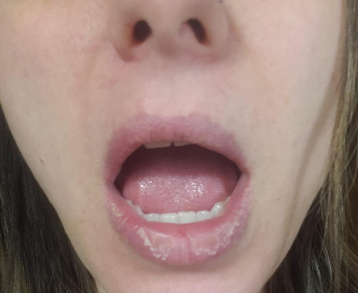 Before image of a reviewer's lips showing dryness and cracks.