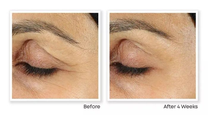 Before and after photos showcasing the remarkable transformation of an eyelid after four weeks of beauty treatment, visibly diminishing wrinkles and fine lines.