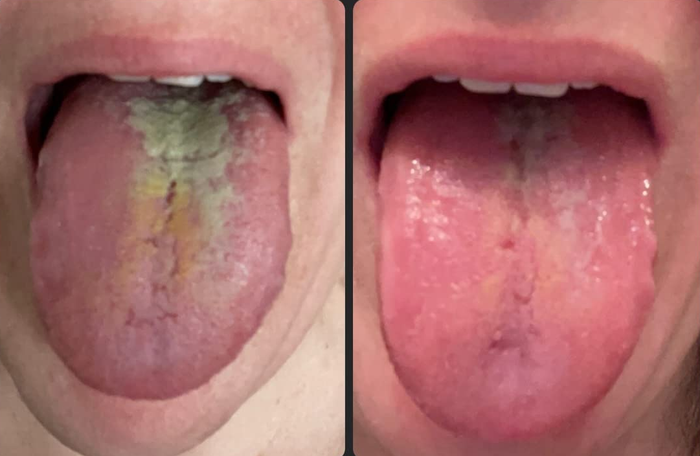 Reviewer's tongue before and after using the tongue scraper, showing a noticeably cleaner tongue.