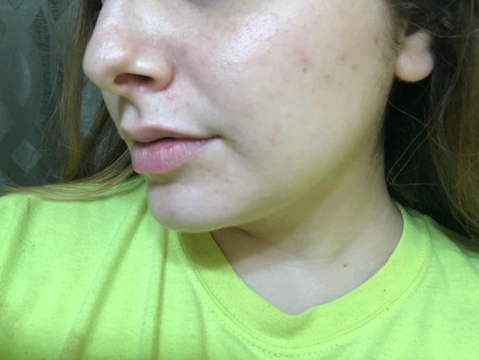 The same reviewer with noticeably clearer skin and no trace of acne.