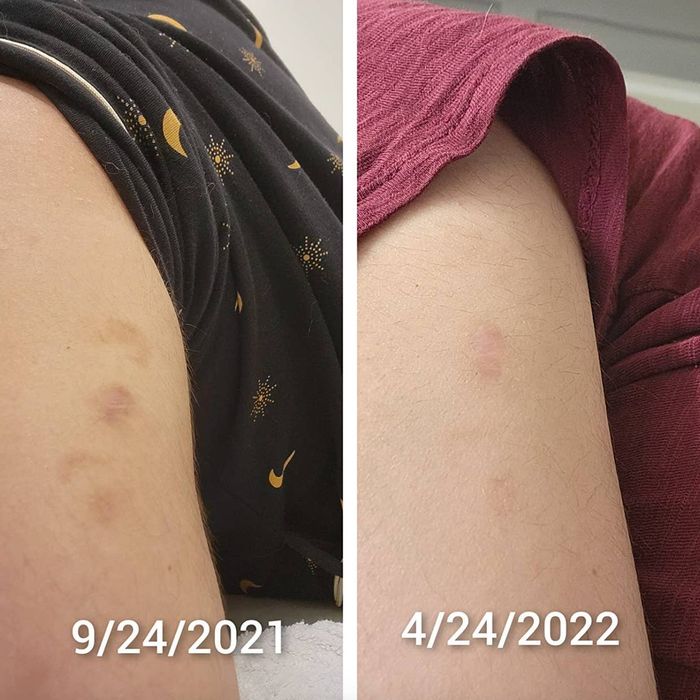 A reviewer's before photo showing skin with visible scars, followed by an after photo where scars have significantly faded thanks to Bio-Oil.