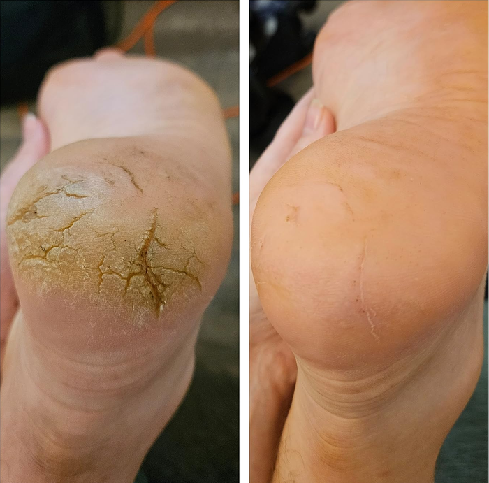 Before and after images of the reviewer's foot, showing the impressive transformation after using the callus remover