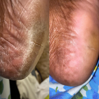 Before and after comparison of a reviewer's cracked heel, revealing softer, smoother, and pinker skin after the treatment