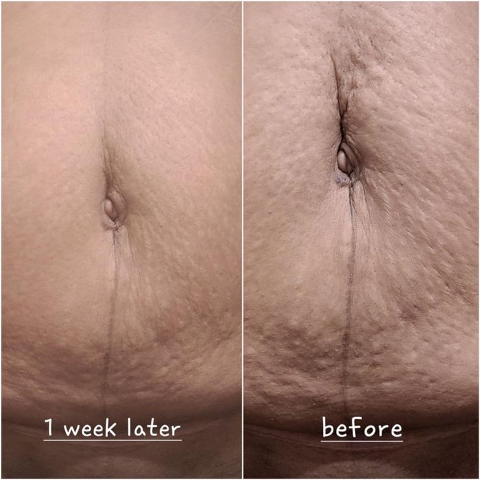 Side-by-side image of the same person’s abdomen showing visible skin improvement after using the product for 1 week