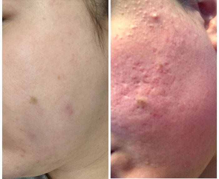 A reviewer's before/after showing a reduction in redness, texture, acne, and scarring