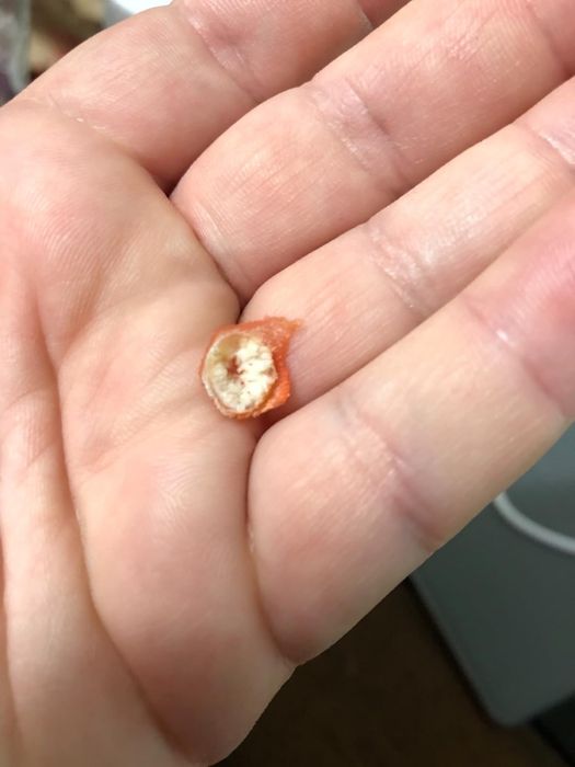 The reviewer holding the corn that has fallen off their foot after treatment