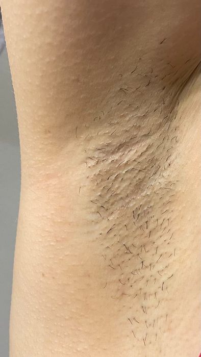A reviewer showing hair growth in their armpit.