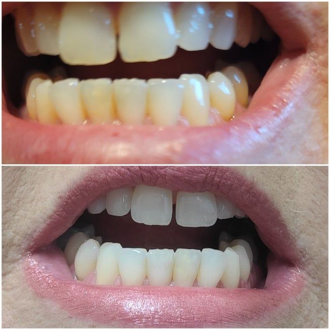 A reviewer showing a before-and-after shot of their teeth, with the whitening pen visibly brightening their yellowed teeth