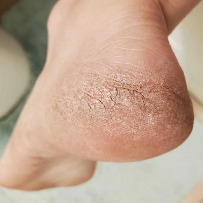 Reviewer’s before photo showing their dry, cracked, and crusty foot