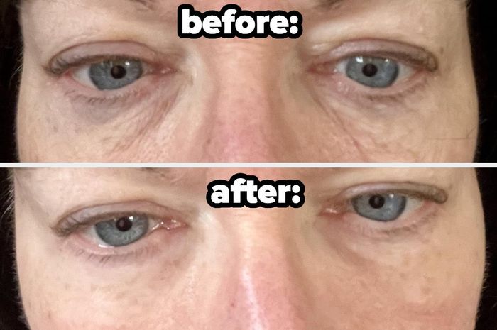 Reviewer showing before and after photos, where their puffy under-eye bags are completely gone after using the product