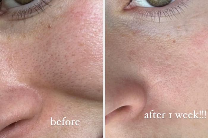 Close-up of a person’s cheek showing before and after one week of skincare treatment, with visible reduction in pores and smoother skin in the after image. Text: 