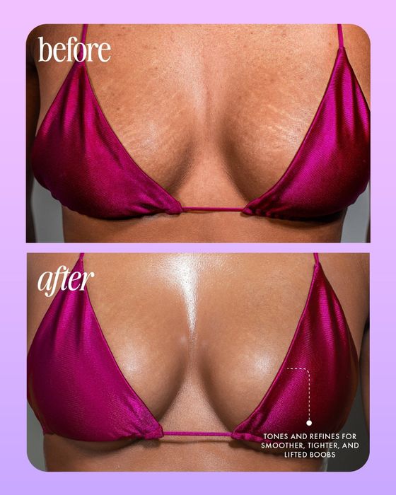 Before and after images of breasts with visibly reduced stretch marks.