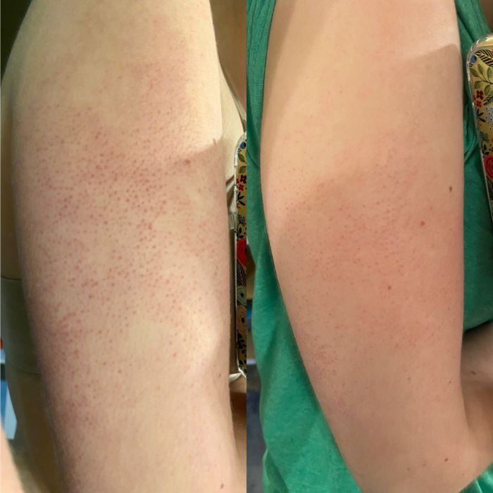 Left: before photo of the reviewer's red, bumpy arm. Right: after using the scrub, the arm appears visibly less red and with fewer bumps.