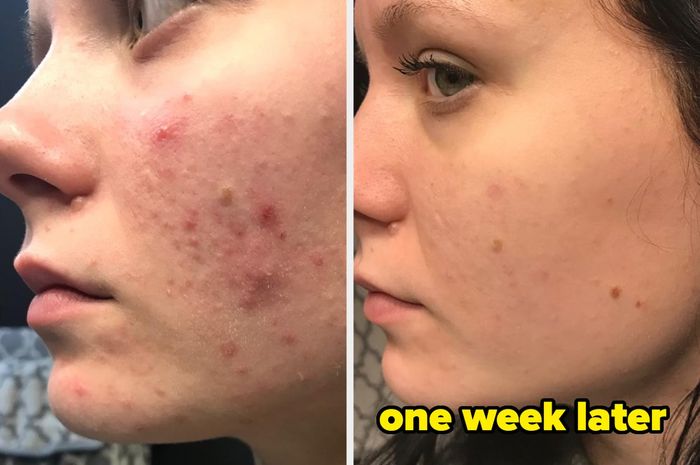 Two side-by-side close-up images showing a person's cheek with acne before and after one week of treatment.