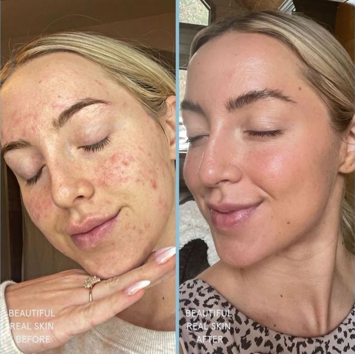 Before (acne present) and after (clear skin) image of a model using the Meltdown Acne Oil.
