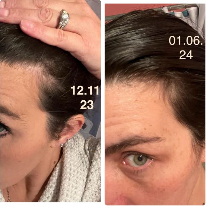 A side-by-side comparison of a reviewer's hairline before and after one month of using the product, showing visible growth around the temples.