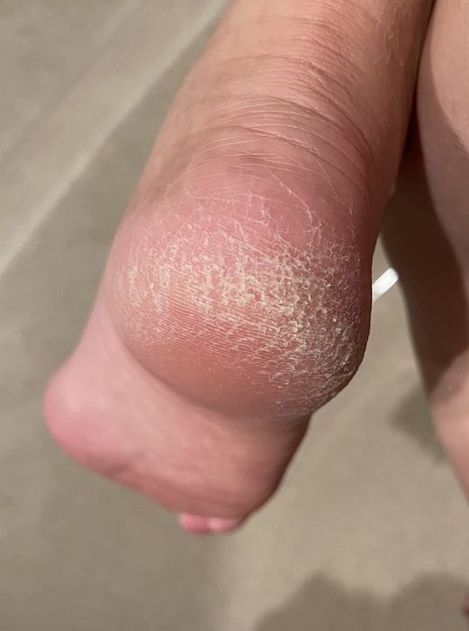 Reviewer photo of foot before using the foot file