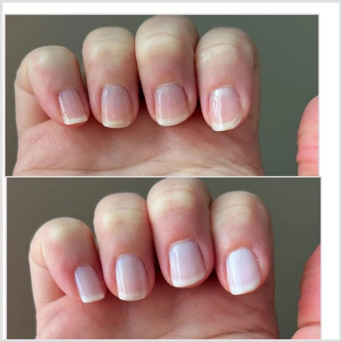 Reviewer's nails before and after using the nail concealer