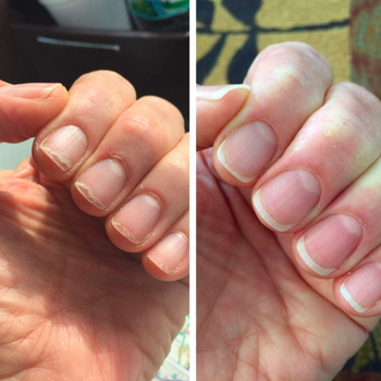 A before and after shot of damaged nails next to nails that look healthier and stronger
