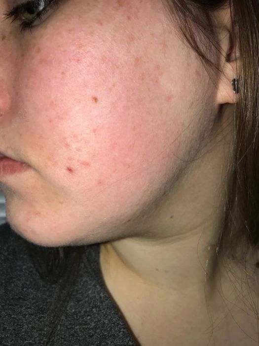Customer’s before photo showing a red, bumpy cheek area