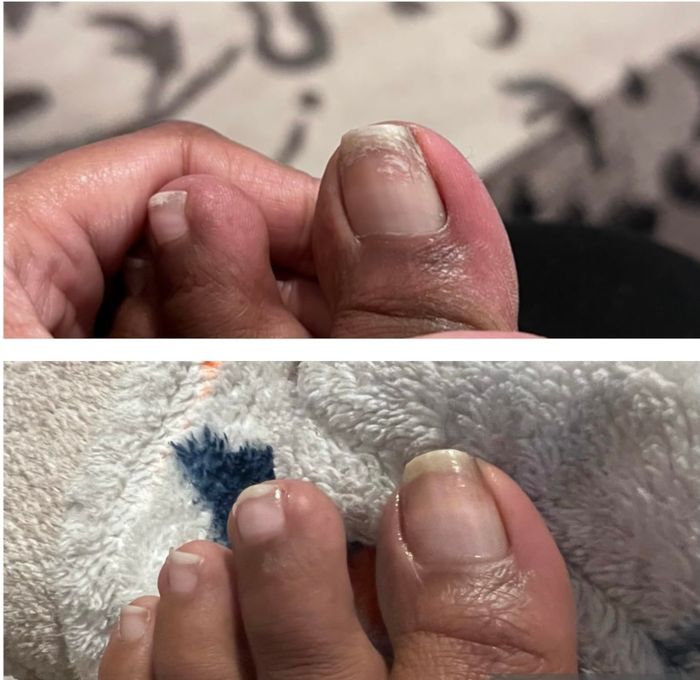 Reviewer's toenail before and after applying CND treatment, revealing a more nourished appearance.