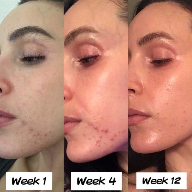A reviewer's photo showing the results after using Differin gel for 12 weeks
