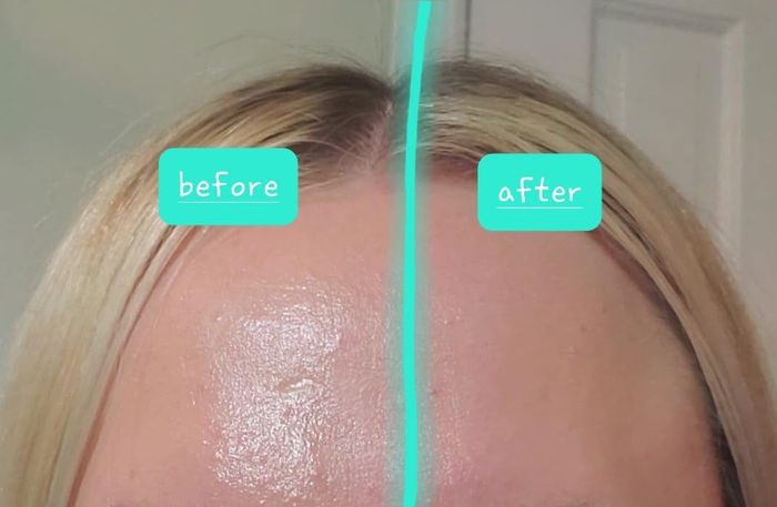A reviewer's forehead with one side oily and the other side freshly rolled with the face roller, showing a noticeable reduction in shine.