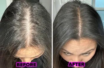 A reviewer’s hairline before, showing more scalp, and after, looking fuller and thicker