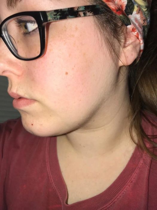 Customer’s after photo showing the same cheek now much less red and nearly clear of breakouts