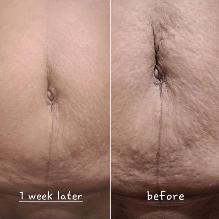 A reviewer's before and after photo showing their tummy with loose skin before using the cream and tight skin afterward