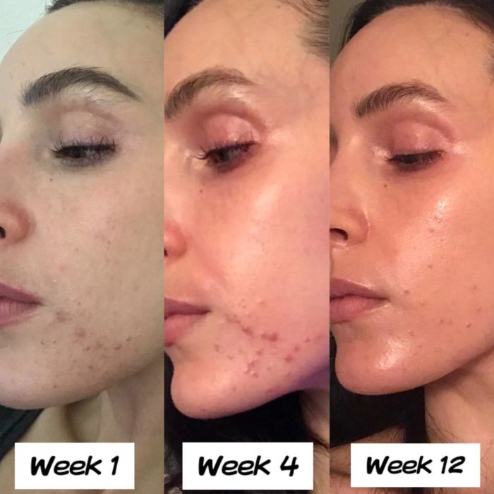 Reviewer photo showing results of using Differin gel over a 12-week period