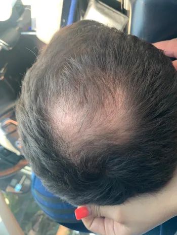 The same reviewer's hair appears visibly thicker after using the biotin shampoo.