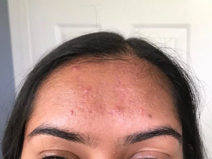 Reviewer showing their forehead after using oil blotting sheets