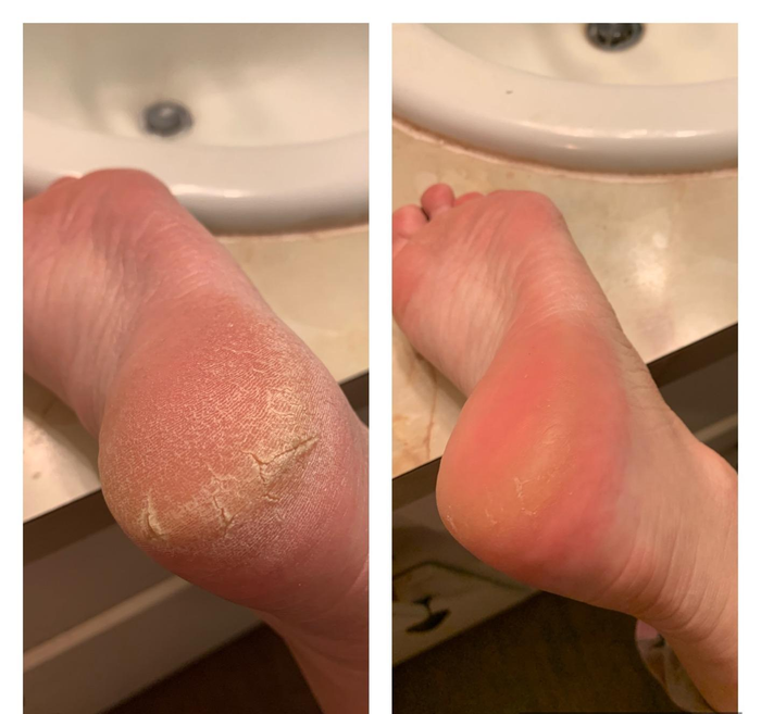Reviewer showing before and after results of using O'Keeffe's Healthy Feet foot cream