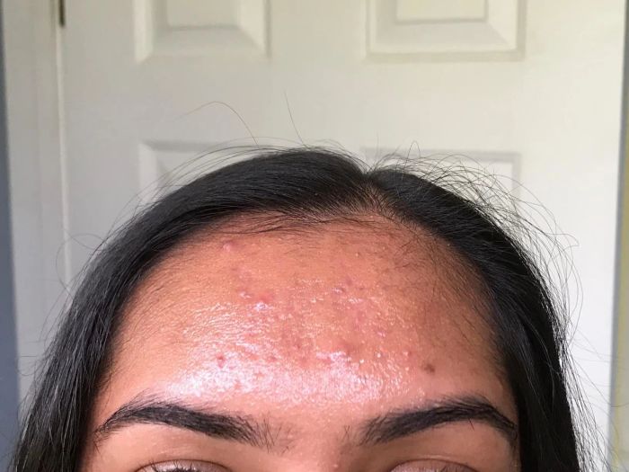 Reviewer showing their forehead before using oil blotting sheets