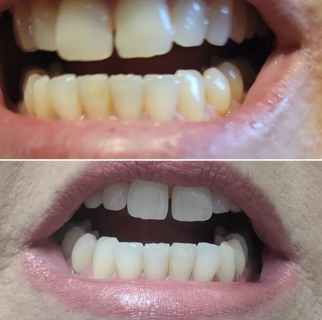 Before and after images showing teeth before and after using the whitening pen, with noticeable improvement in brightness.