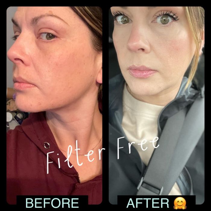Reviewer's face before and after applying E.l.f. Camo concealer.