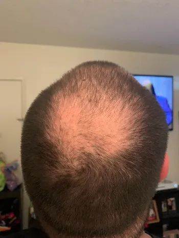 A reviewer showcasing their thinning hair before they began using the biotin shampoo.