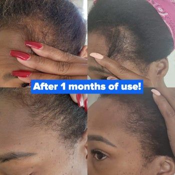 A reviewer showcasing new hair growth after using the oil with text reading