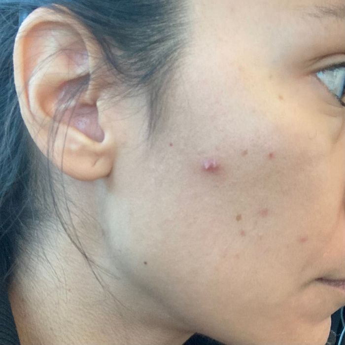 Close-up shot of a person’s cheek with visible acne marks