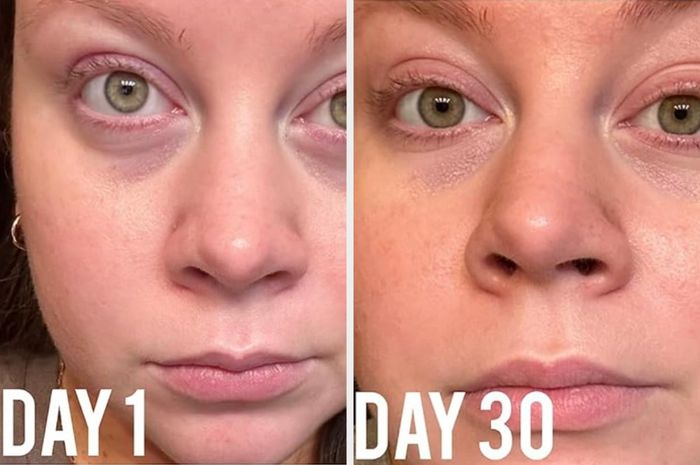 Before and after close-up of a reviewer's face, showing a visible reduction in dark circles under their eyes over the course of 30 days