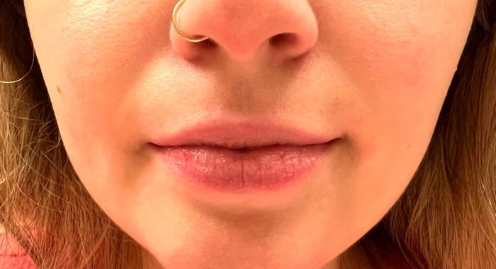 Reviewer's lips before using the Hanalei lip scrub, showing signs of dryness and flakiness