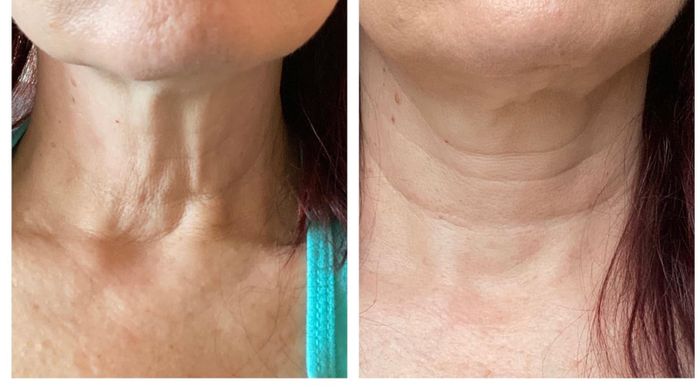Close-up of reviewer's neck before and after using neck cream