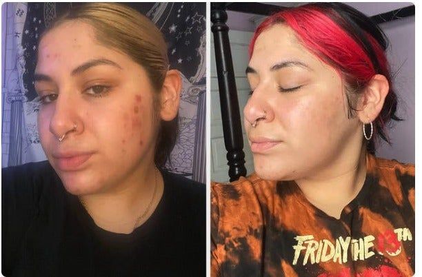 Reviewer's skin before and after applying the vitamin C serum, showing noticeable improvements