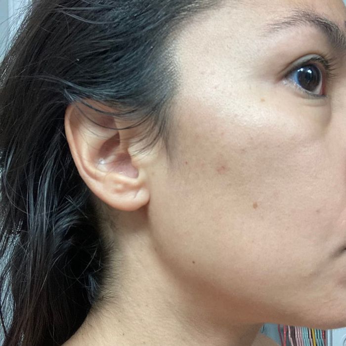 Close-up of the same person’s cheek showing a noticeable reduction in acne blemishes