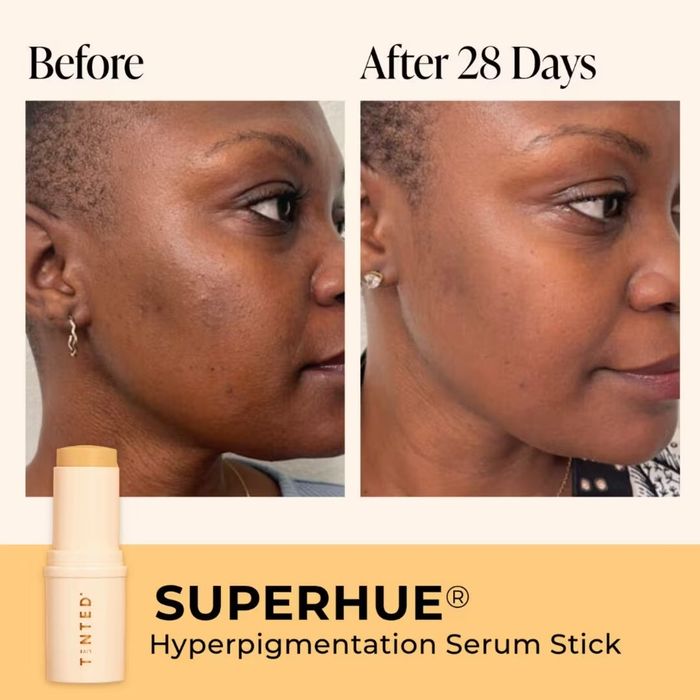 before and after of model's skin with hyperpigmentation before and dark spots faded after using the serum stick