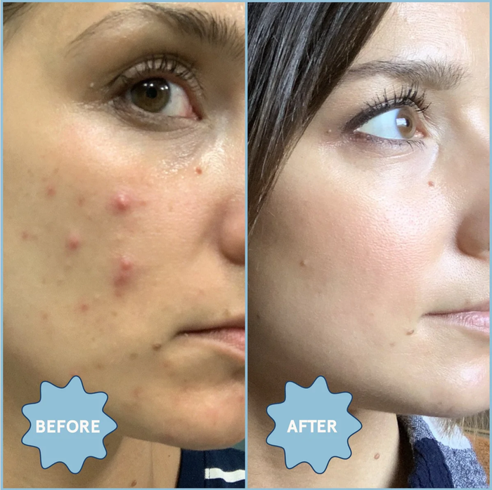 Model before (acne present) and after (clear skin) using the product