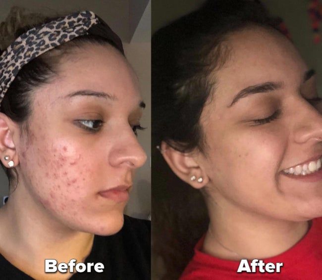 Before and after photos of a reviewer showing their cystic acne before and after using the cleanser.